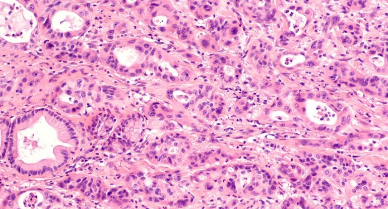 Xərçəngin inkişafına səbəb olan iki vitamin açıqlanıb