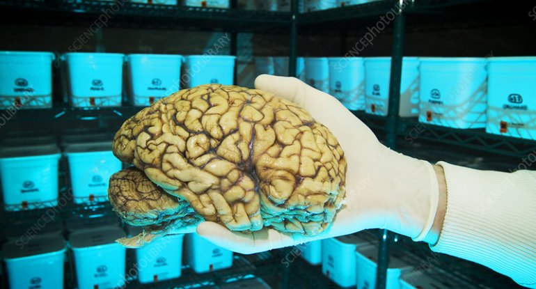Dünyada beyin saxlanılması üçün ilk biobank yaradılıb