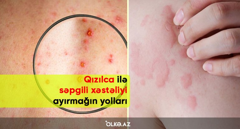 Qızılca ilə səpgili xəstəliyi ayırmağın yolları - Peyvəndlə bağlı suallara CAVAB