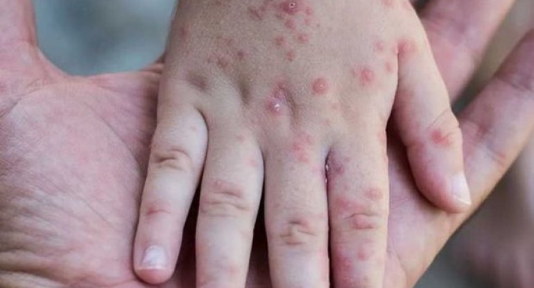 ÜST Avropada qızılca epidemiyasının səbəbini açıqladı