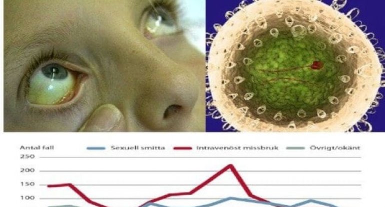 Hepatit A virusunu necə tanımalı? - Hepatoloq açıqladı - MÜSAHİBƏ 