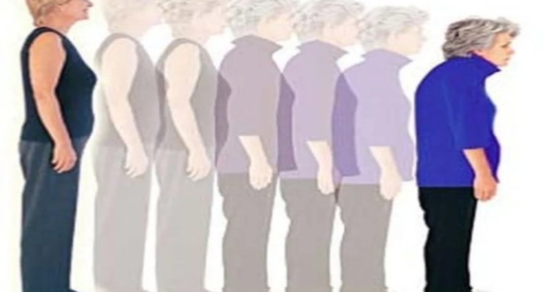 Niyə insanın boyu qocalanda azalır? - Səbəbi AÇIQLANDI