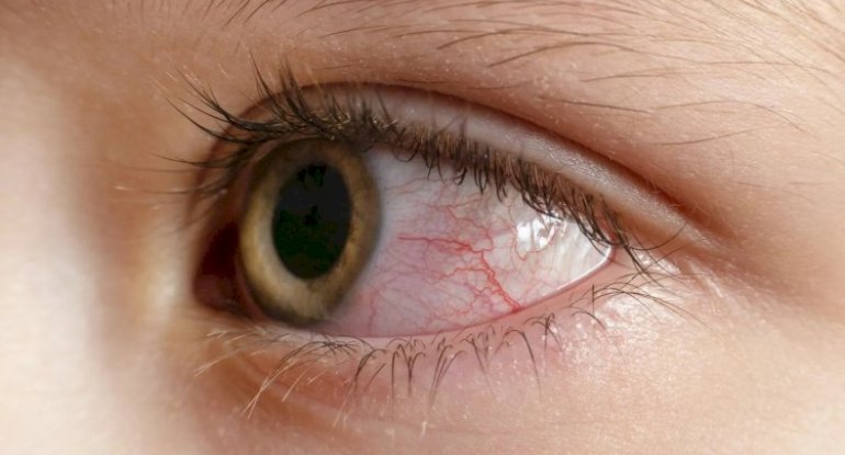 Qızartı, qabıqlanma, şişkinlik: İnsanları kor edən yeni virus