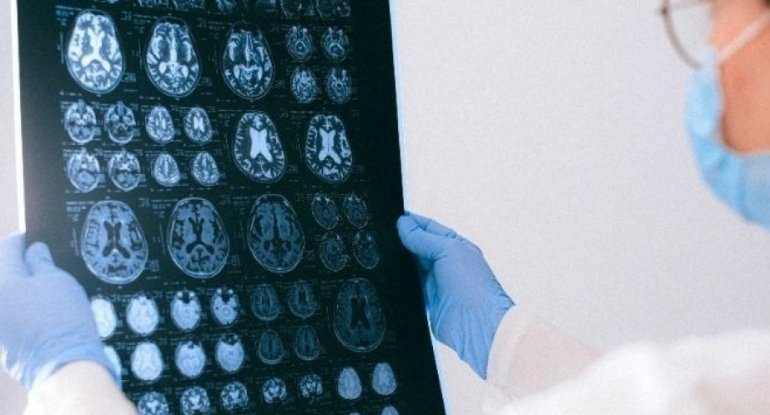 Dünyada ilk: 13 yaşlı uşaq ölümcül beyin xərçəngindən tamamilə xilas olub