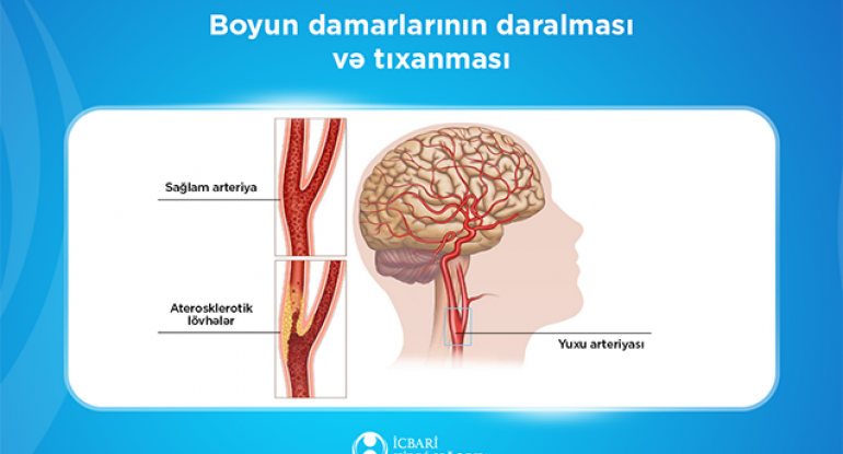 Bu müalicə də icbari tibbi sığortaya daxildir