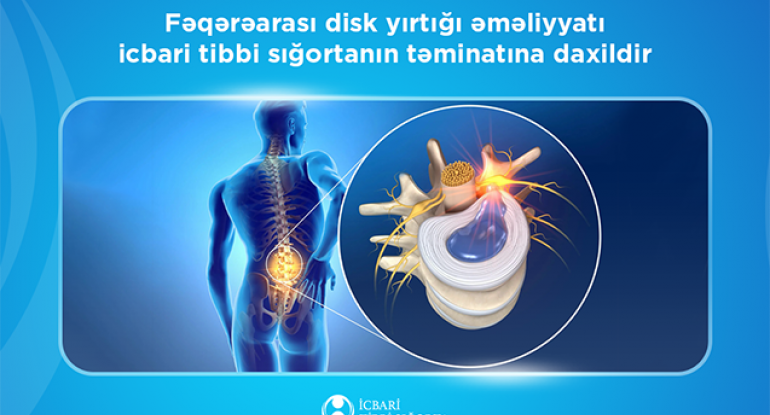 Bu əməliyyat da icbari tibbi sığortanın təminatına daxildir