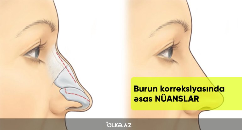 Burun korreksiyasında ƏSAS NÜANSLAR – Dolğudan sonra burun çürüyə BİLƏR? - MÜSAHİBƏ