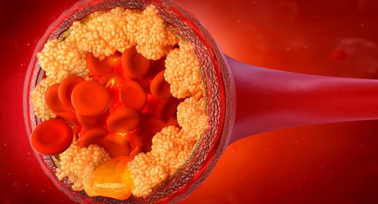 Dietoloq xolesterolu aşağı salan qidaları açıqladı