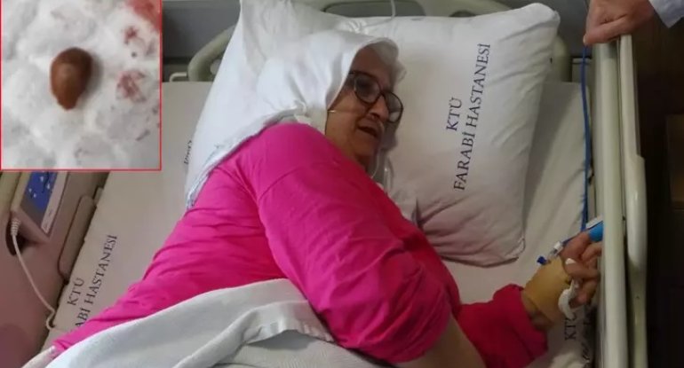 Meyvə tumu udan qadının ciyəri çürüdü