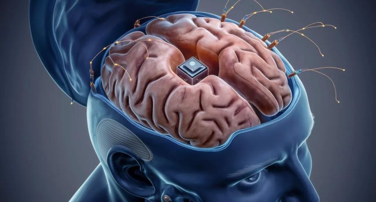 İnsan-beyin interfeysi reallığa çevrildi &ndash; "Neuralink"dən uğurlu nəticələr
