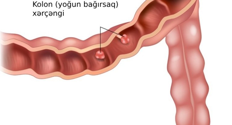 Bu qidalar bağırsaq xərçənginə səbəb olur - ADLAR