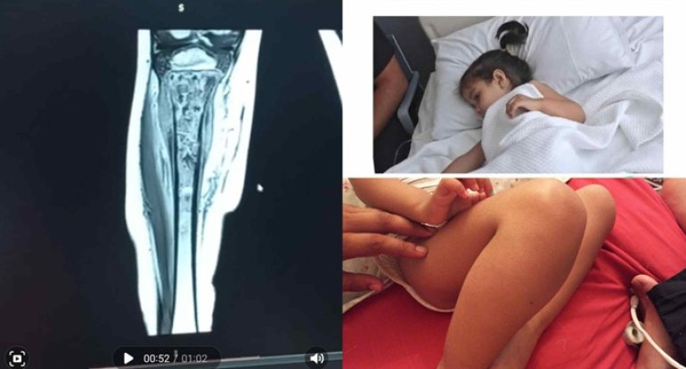 3 yaşlı Zümranın yaşamaq üçün köməyinizə ehtiyacı var - FOTO