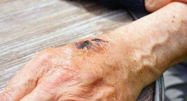 Azərbaycanda qarayaraya yoluxanların sayı artıb