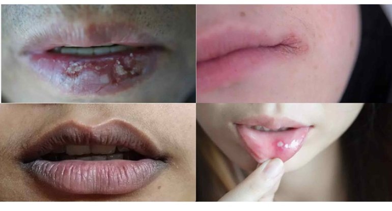 Uçuq kimi görünsə də, ciddi xəstəliklərin əlaməti ola bilər