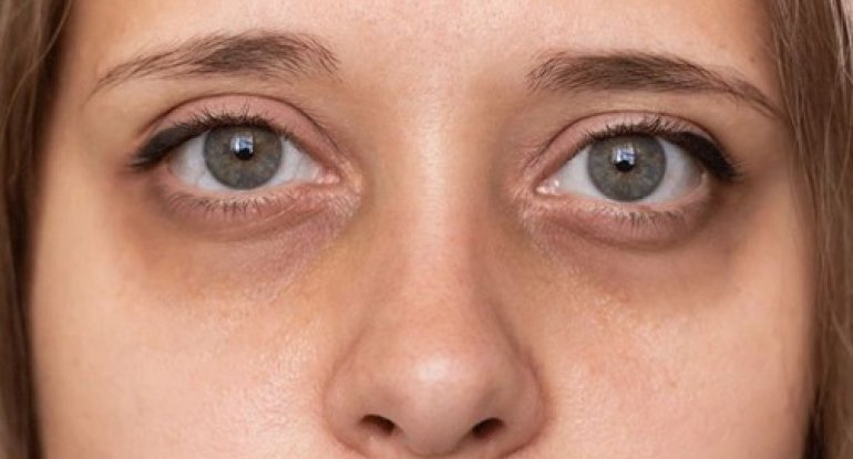 Gözaltı göyərmə və qaraltılar &ndash; Hansı xəstəlikdən xəbər verir?