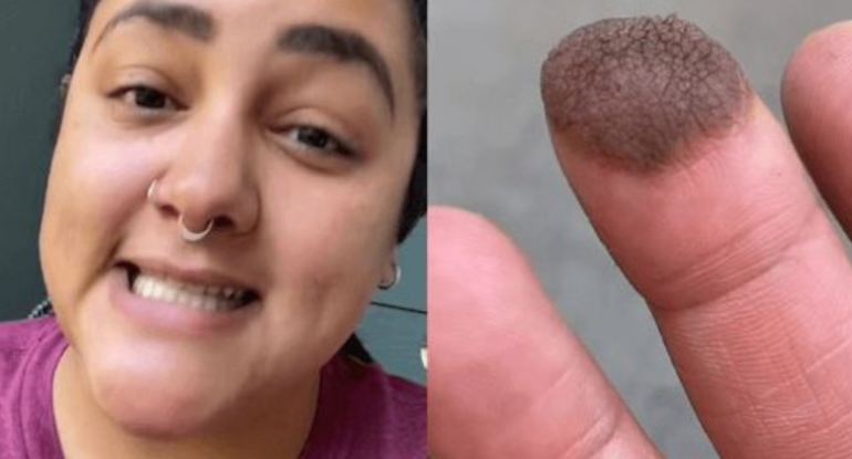 Dəri transplantasiyası olan qızın barmağından tüklər çıxdı - FOTO