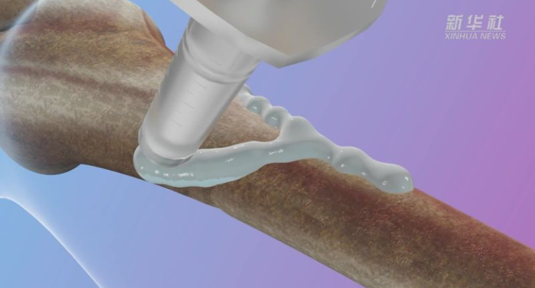 Çin alimləri sınıqları 3 dəqiqəyə sağaldan &ldquo;sümük yapışdırıcısı&rdquo; hazırladılar