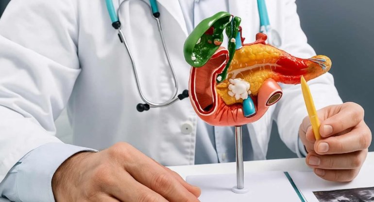 Mədəaltı vəzin çürüyüb nekrozlaşması &ndash; Necə bilinir?