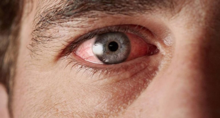 Gərginsinizsə bu vitamininiz çatışmır