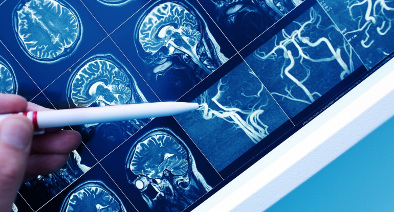 Ağır epilepsiyanın müalicəsində İNQİLAB