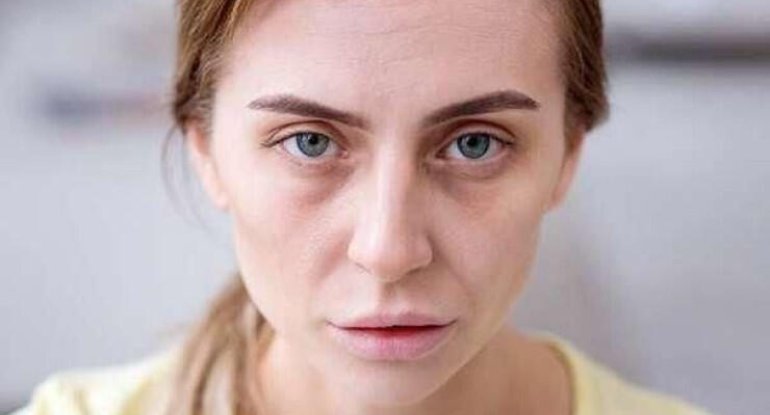 Üzün solğun olması hər zaman qanazlığı demək deyil - Həkim
