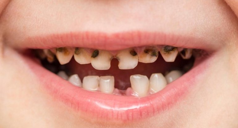 Diş sağlamlığını məhv edən qidaların siyahısı