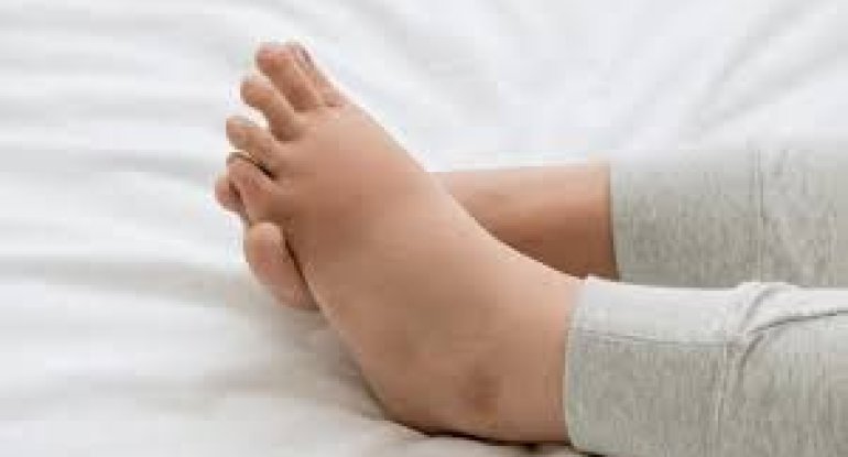 Ayaqların qəfil şişməsi qaraciyərdən ola bilər