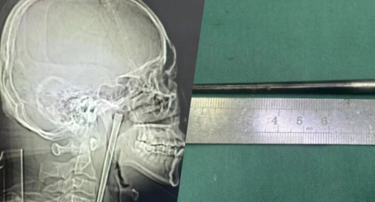 8 il boğazında 12 santimetr uzunluğunda bir çubuqla yaşadı
