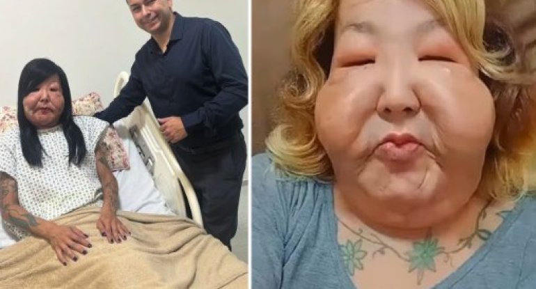 Gözəllik naminə üzü tanınmaz hala gəldi - FOTO