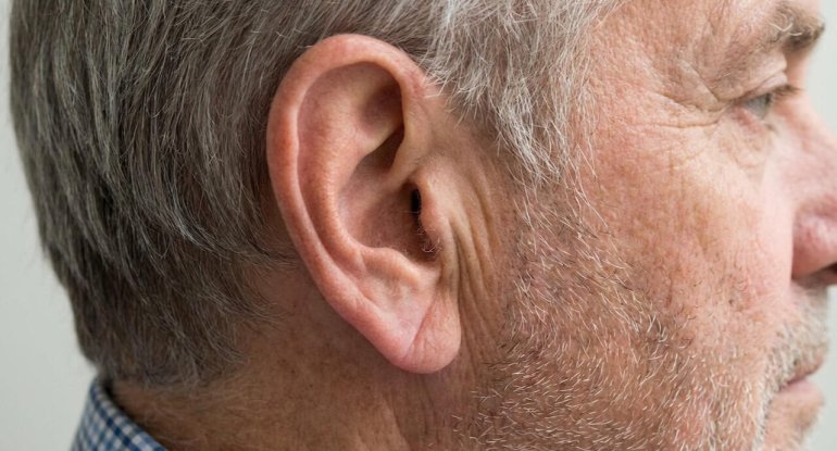 Qulaqdakı bu xətt infarkt riskini göstərir