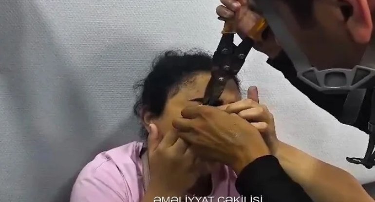 Göz qapağı zəncirbəndə ilişdi, FHN xilas etdi - Video