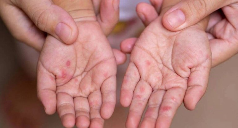 Bu ölkədə epidemiya böyüyür: Ölən uşaqların sayı 712-yə çatdı
