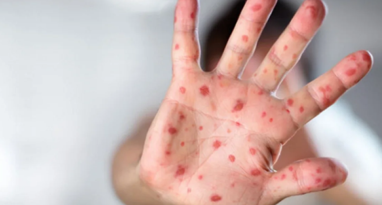 Qızılca və suçiçəyi ilə bağlı epidemioloji vəziyyət açıqlandı