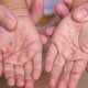 Bu ölkədə epidemiya böyüyür: Ölən uşaqların sayı 712-yə çatdı