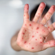 Qızılca və suçiçəyi ilə bağlı epidemioloji vəziyyət açıqlandı